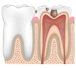 Dentine decay